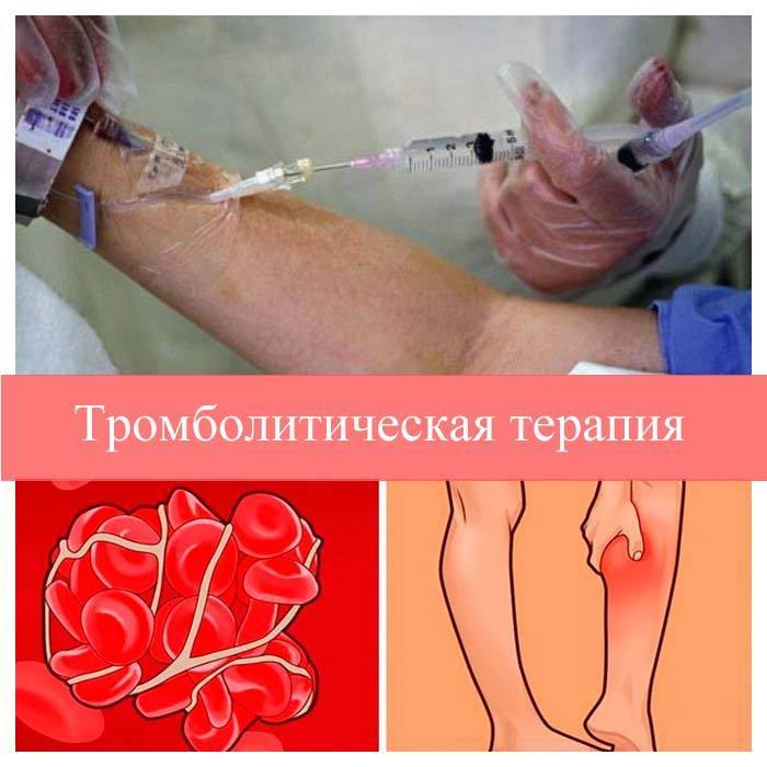 Тромболітична терапія - що це таке, показання до проведення, протипоказання » журнал здоров'я iHealth 