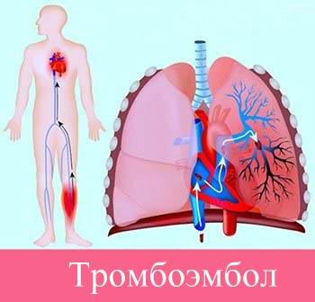 Діагностика тромбоемболії легеневої артерії - методи терапії, заходи профілактики » журнал здоров'я iHealth 1